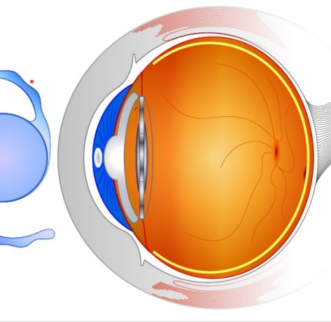 Types of Intraocular Lenses (IOLs)