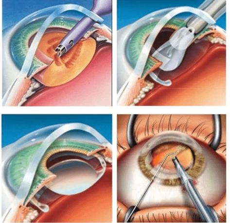 Cataract Surgery: What You Need to Know